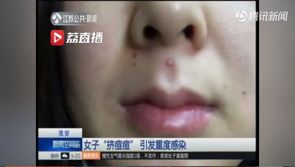 挤了人中的痘痘头晕,挤完人中痘痘后害怕颅内感染