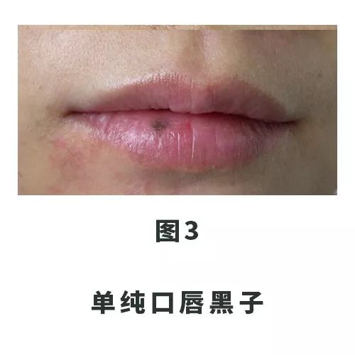 口唇黑斑,口腔里和嘴唇长满了黑点