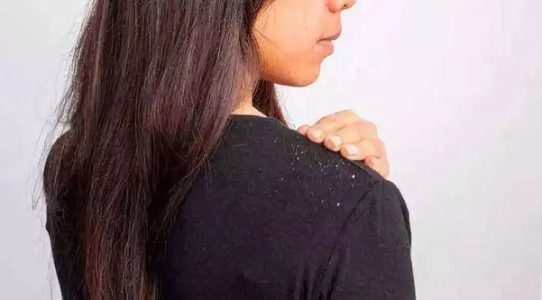 头皮屑多怎么办教你一招解决,头皮屑多怎么办教你一招