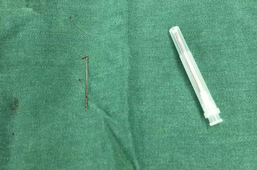 惊险！温州一婴儿连续几天吐血竟是误食了一根针！