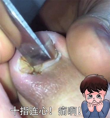 小脚趾甲长在肉里一碰就疼怎么办,指甲扎到肉里怎么处理