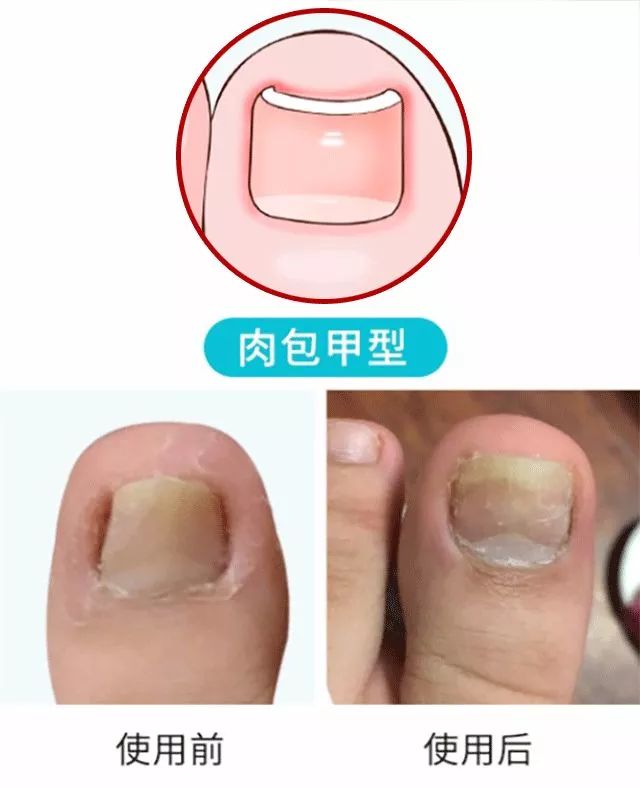 趾甲扎进肉里了，一碰就痛？用它一贴，1分钟止痛，趾甲往外长，再也不扎痛了！