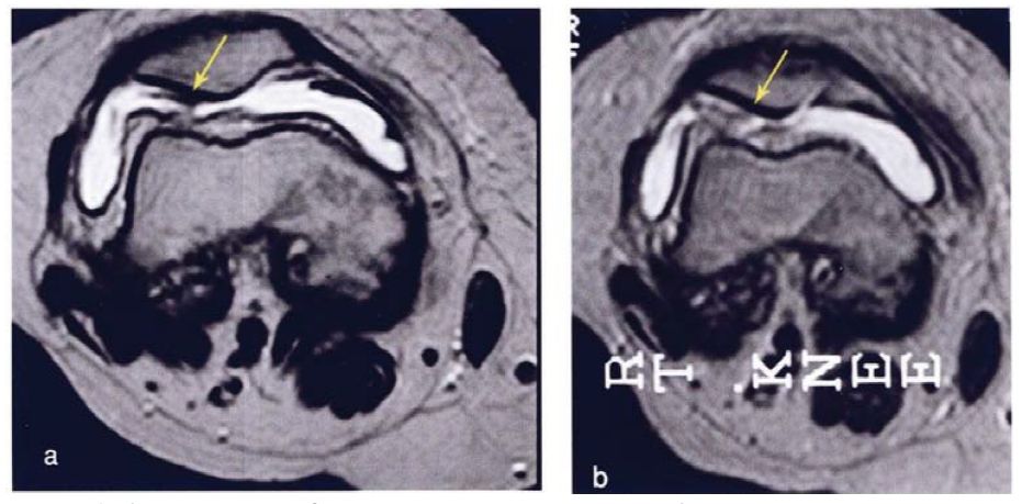 膝关节软骨退化干细胞治疗,间充质干细胞治疗膝关节