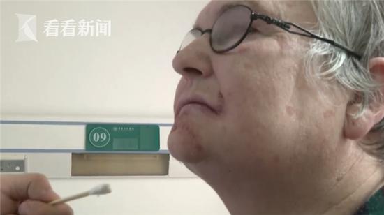 嘴唇上长了黑斑警惕某些部位病变,上嘴唇起了一个瘤说是癌症