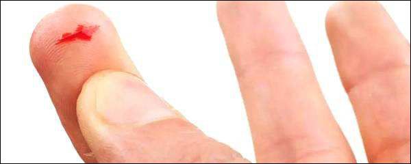 手指被割伤了为什么会肿,手指被割伤为什么会肿