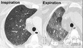 胸部解剖及常见疾病影像表现,胸部影像学基础知识