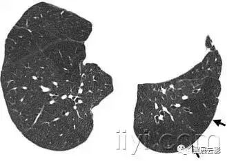 胸部解剖及常见疾病影像表现,胸部影像学基础知识