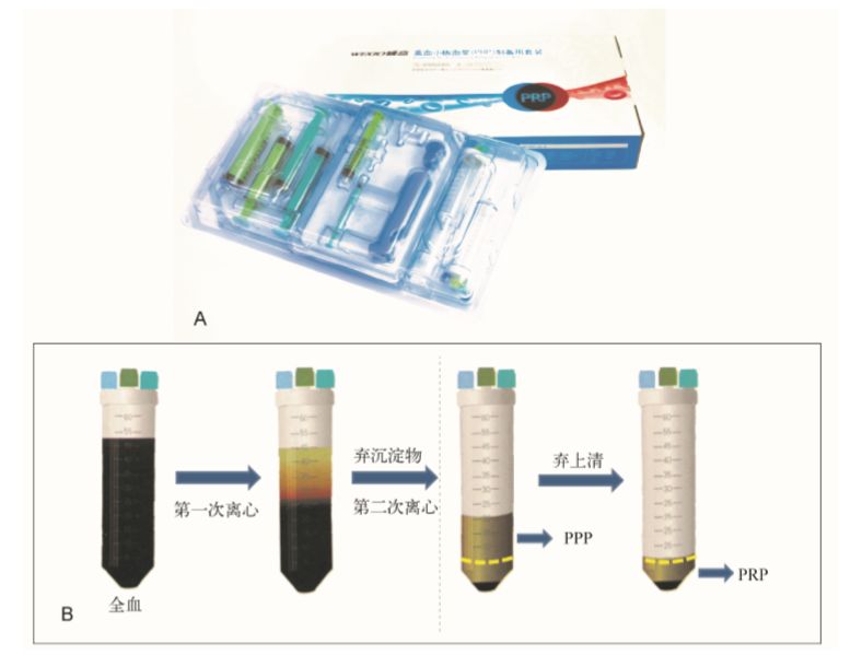 富血小板血浆技术治疗适应症,富血小板血浆计数的目的和意义