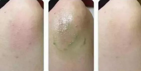 泰国防蚊子药膏,泰国蚊子叮的药膏