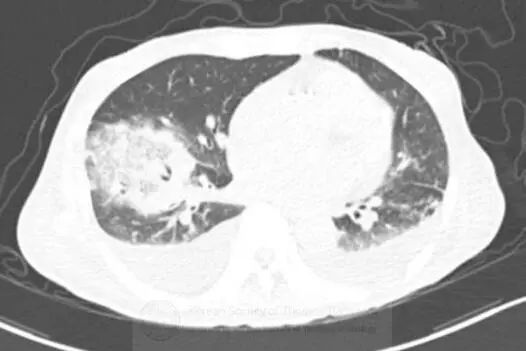 肺空洞性实变是什么原因,肺空洞症状