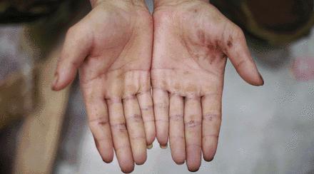 双手起满老茧的男孩,17岁男孩长了手上老茧