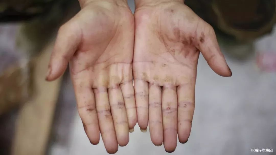 双手起满老茧的男孩,17岁男孩长了手上老茧