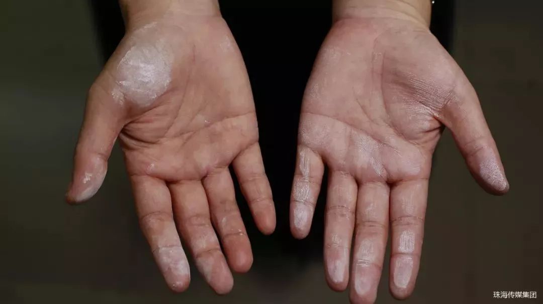 双手起满老茧的男孩,17岁男孩长了手上老茧