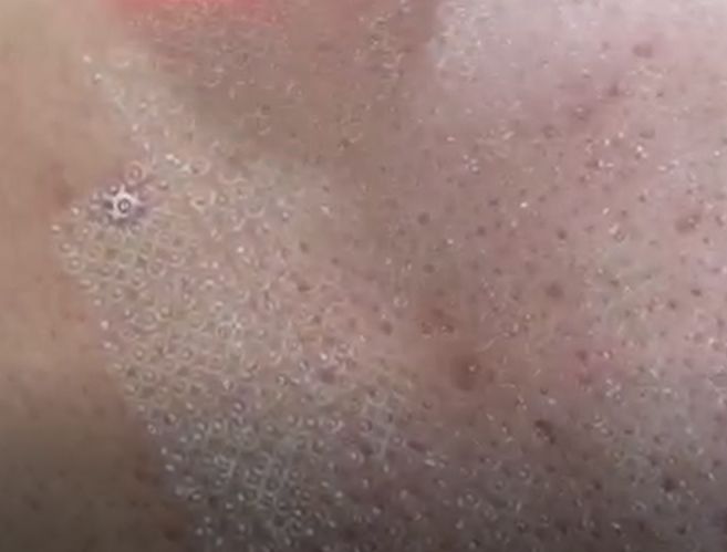 毛孔粗大到能插秧4招教你缩回去,脸上毛孔粗大跟插秧一样