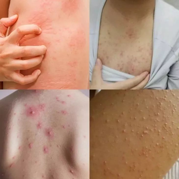 教你1分钟清除99%的脸上螨虫,10秒祛螨虫的药膏