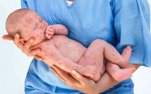 水痘会不会致死,水痘要人命吗