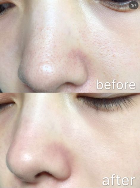 痘痘黑头清理方法,彻底解决痘痘黑头