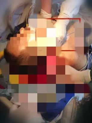 惊险男子身悬18楼外消防奋力营救,惊险浙江男子手被锯断不停喷血