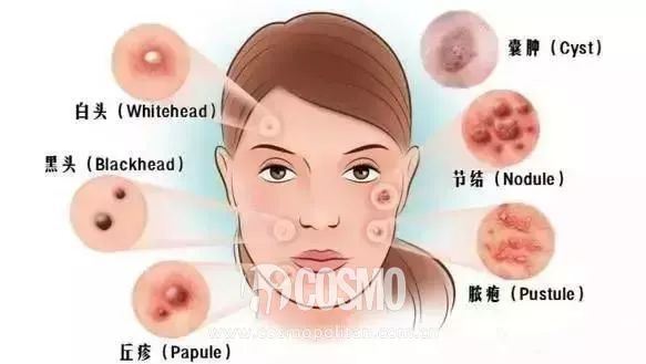 美人计|顽固一年的闭口终于在夏天之前消退了,我用了这些