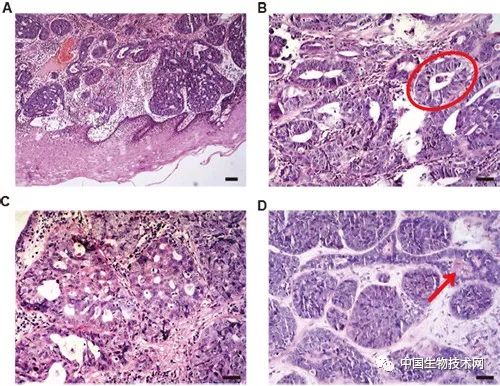 腺样囊性癌为低度恶性肿瘤,全国权威治疗腺样囊性癌的专家