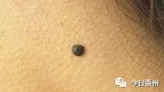 黑痣为什么越长越多中医,中医如何看黑痣