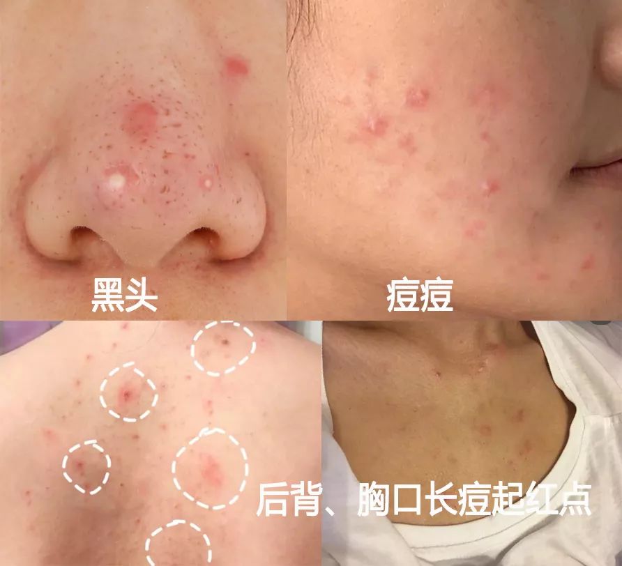 鼻尖挤出白色的是什么,鼻子上挤出的白丝怎么解决