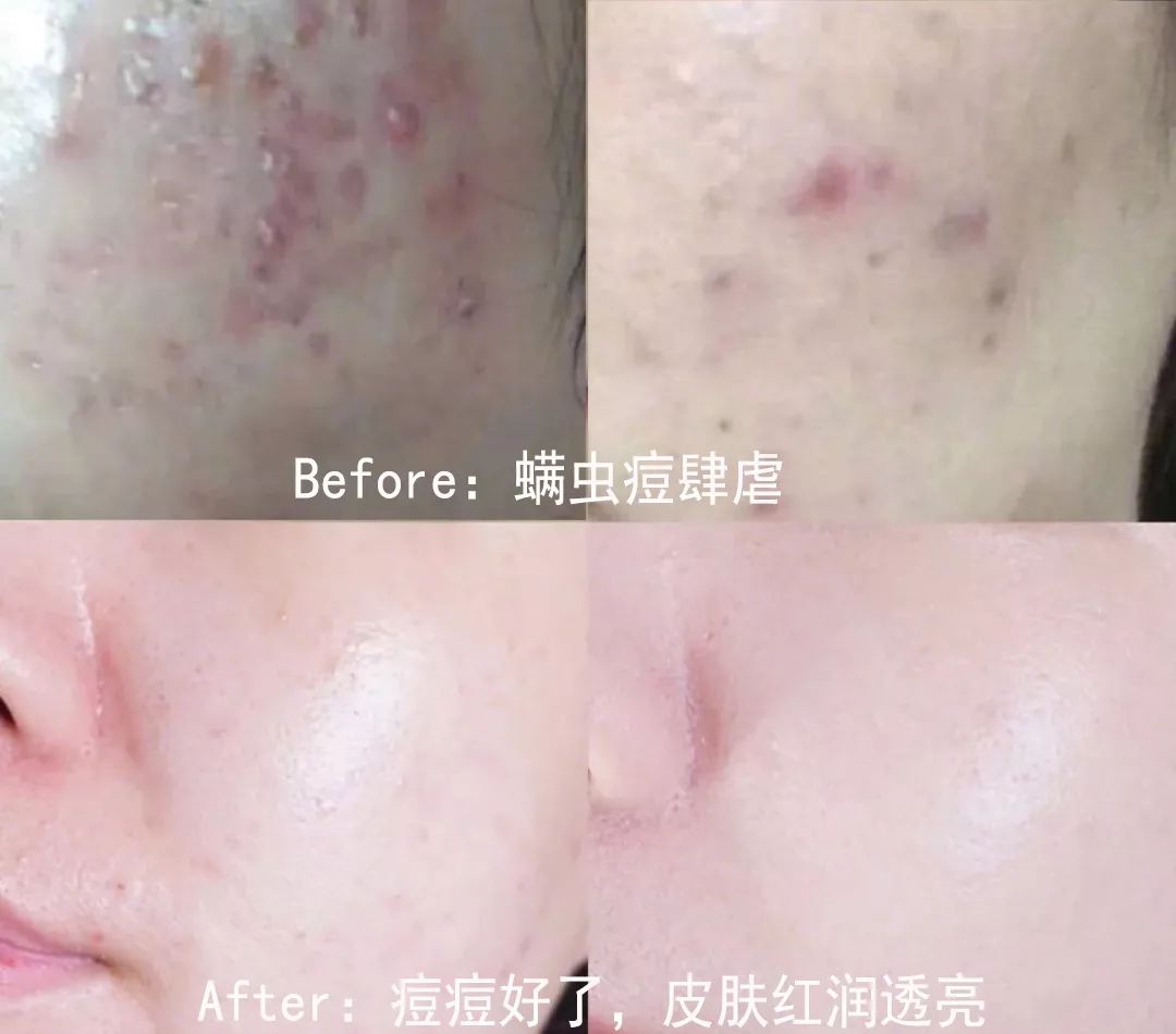 皮肤清洁出黑色的东西,皮肤挤出白色膏状很臭怎么办