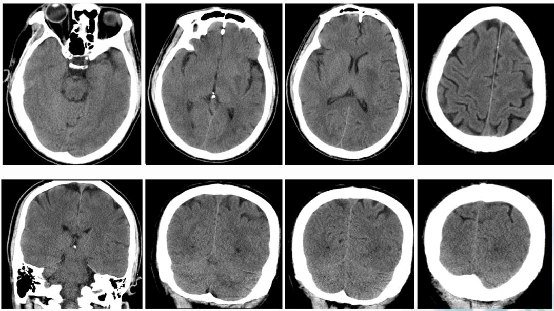 径技·例量|25期：再灌注出血—防不胜防