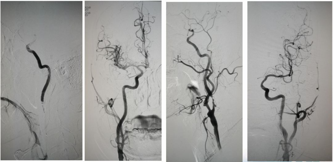 径技·例量|25期：再灌注出血—防不胜防