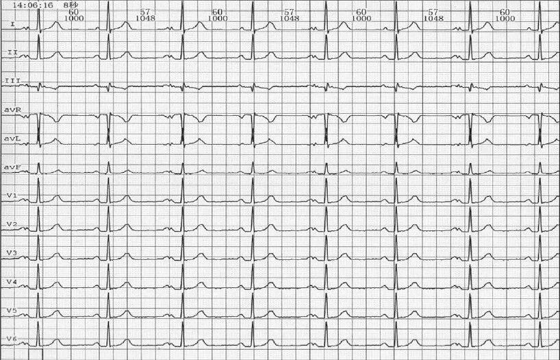 交替变化的P波，揭露房间传导的秘密｜识“图”寻踪