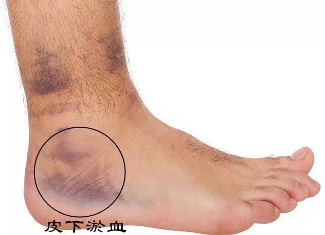 运动扭伤脚踝冷敷还是热敷,扭伤了脚需要冰敷吗还是热敷