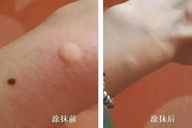 泰国蚊子叮咬止痒膏成人,蚊虫叮咬最管用泰国药膏