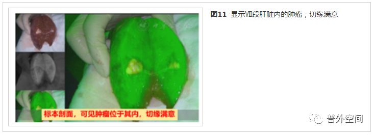 吲哚菁绿荧光引导腹腔镜解剖性肝脏Ⅶ段切除手术流程