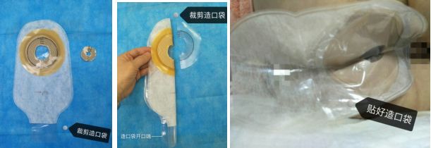 治疗特应性皮炎四步走,怎么快速抑制特应性皮炎的痒