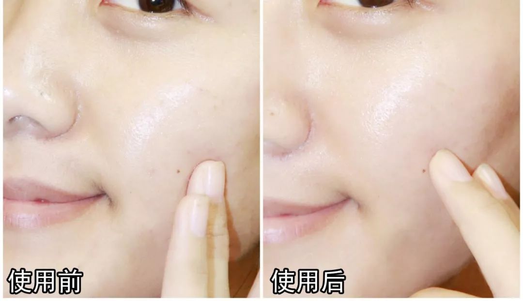 抬头纹法令纹鱼尾纹克星能管用吗,抬头纹鱼尾纹法令纹均可改善