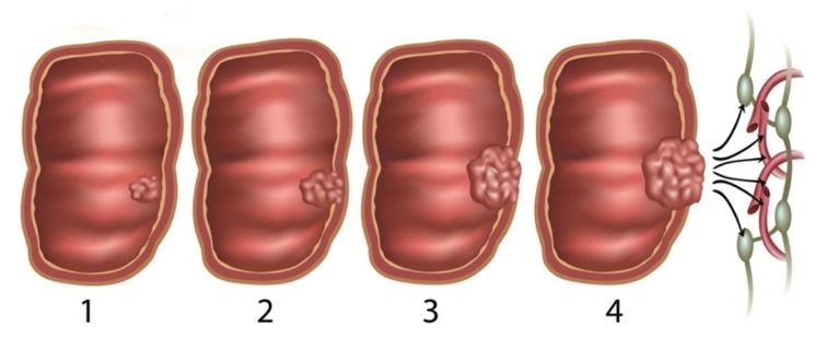 结肠息肉切除术术前准备,结肠镜下息肉冷切除术
