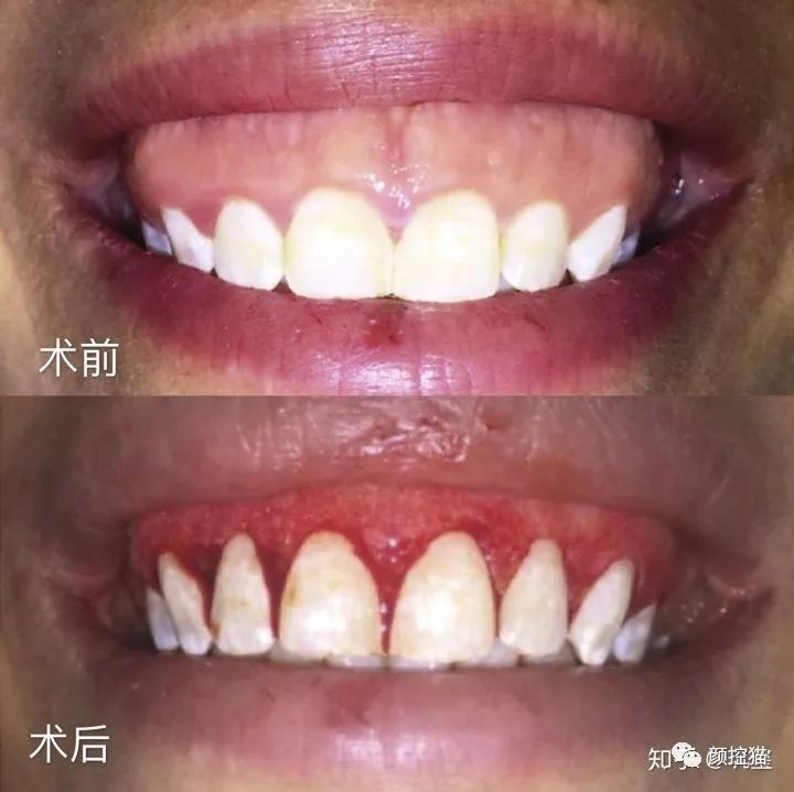 一笑露牙花子能矫正么,一笑就露出牙花怎么办