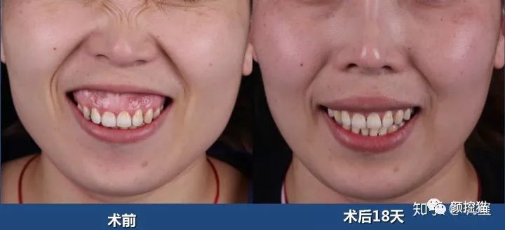 一笑露牙花子能矫正么,一笑就露出牙花怎么办