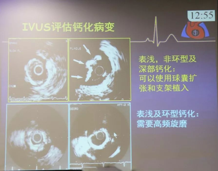 钙化的血管旋磨手术后效果怎么样,occ2019