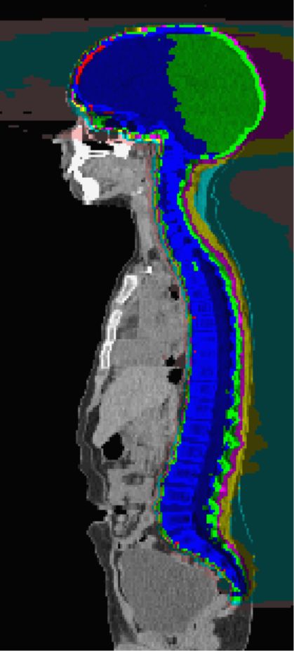 质子重离子治疗副作用大吗,质子治疗肿瘤副作用