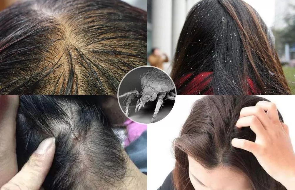 头皮除螨虫神器哪种好用,除头螨头屑小窍门