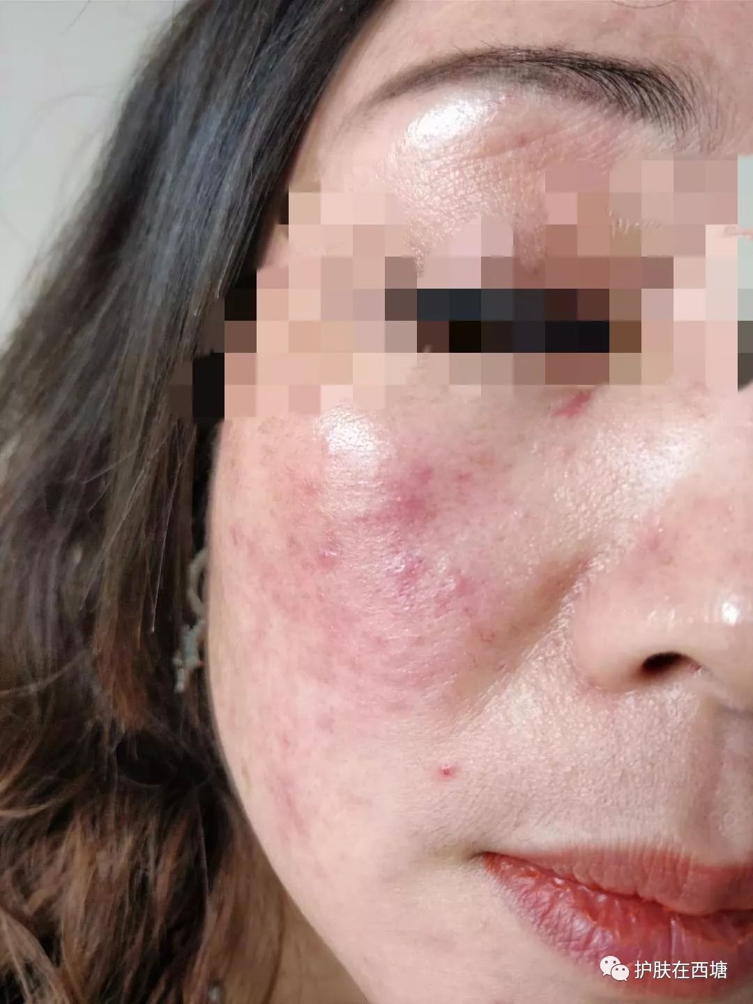 激素依赖性皮炎反复出疹子怎么办,激素依赖性皮炎好了以后怎么护肤