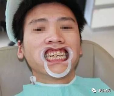 武汉种植牙齿需要多少钱,武汉种植牙齿一颗要多少钱