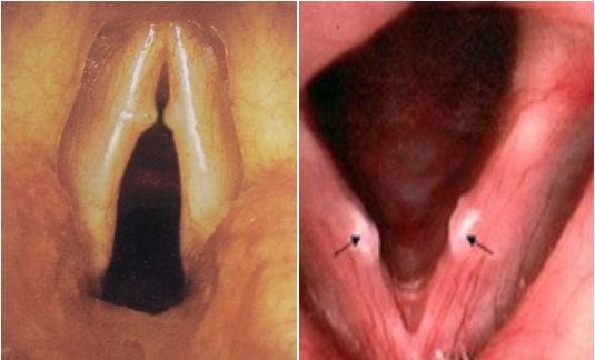 长期说话声音沙哑怎么办,感冒说不出话声音嘶哑是什么原因