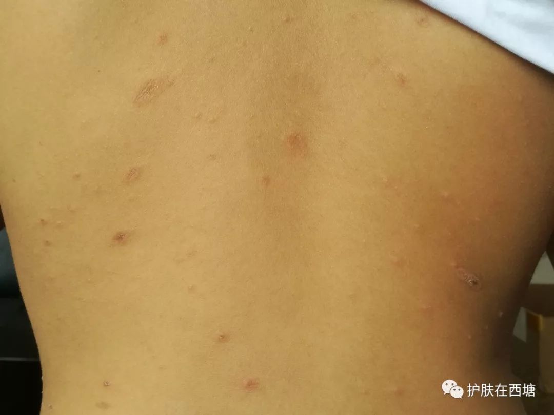 他克莫司软膏治疗脂溢性皮炎,面部皮肤脂溢性皮炎治疗方法