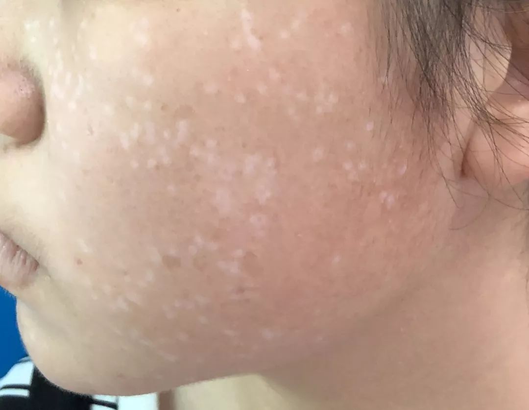 白色花斑糠疹,白色糠疹需要与哪些疾病相鉴别