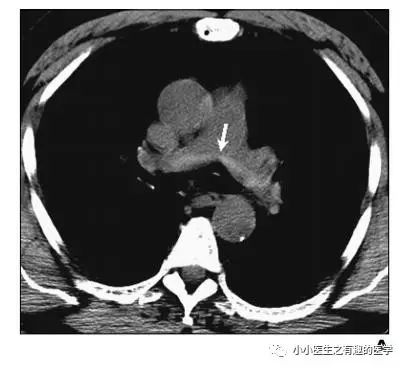 ct平扫肺部能查出是哮喘吗,ct平扫肺结节准确吗