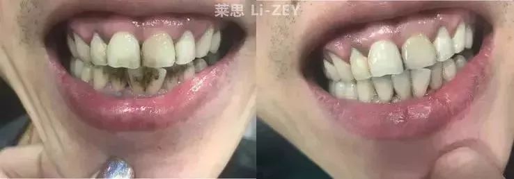 牙黄口臭用什么牙膏最有效贴吧,去牙黄口臭的牙膏最有效