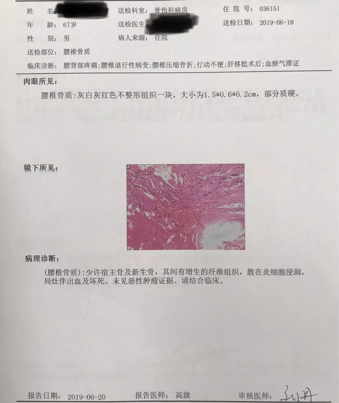 骨科科普压缩性骨折,陈旧性压缩骨折和新近压缩骨折