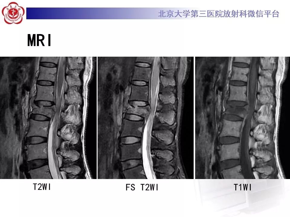 「每日一例｜893例」女，49岁，摔伤致腰部疼痛，活动受限1天